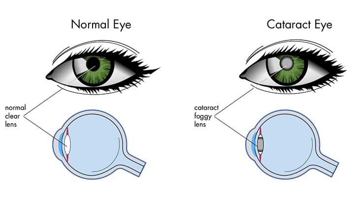 cataract-eye-crossection-copy