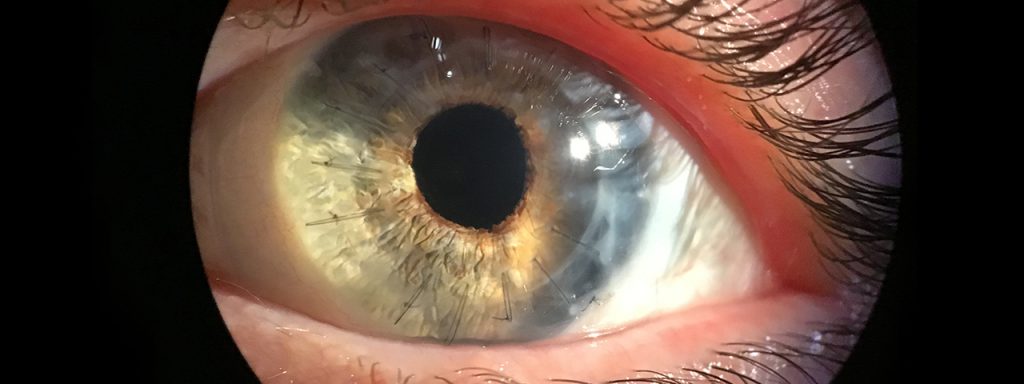 Corneal-Transplant-1280x480-1024x384-1